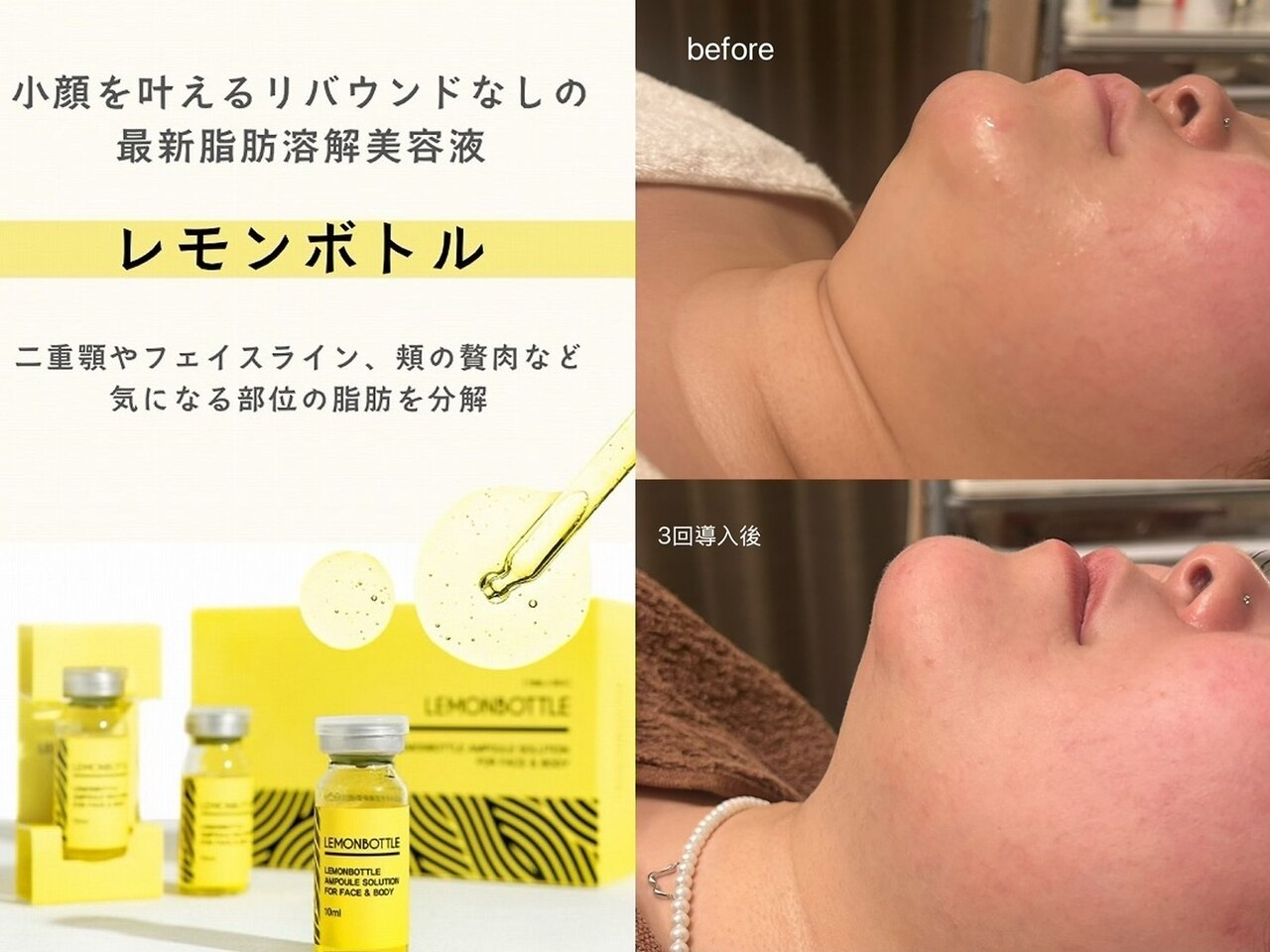 レモンボトル脂肪分解とハイパー痩身90分