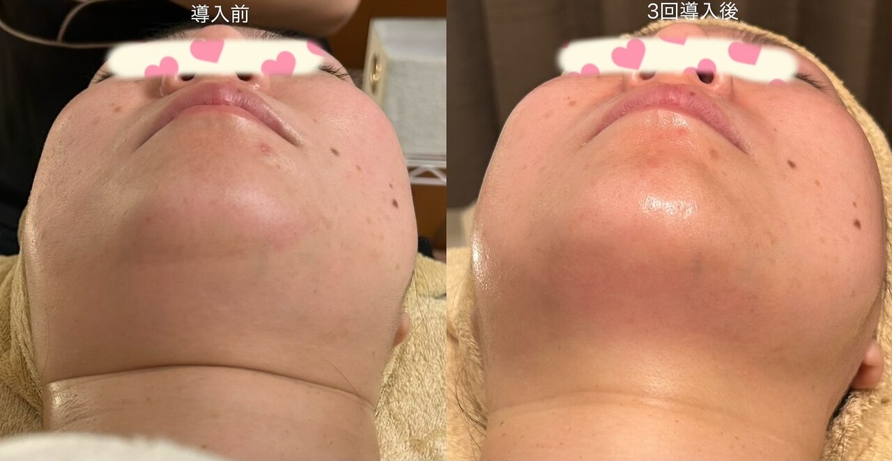 ハイパーナイフ小顔と脂肪分解剤レモンボトル