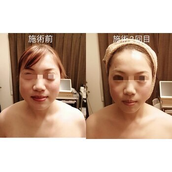 ハイパーナイフ施術によるリフト Before/After