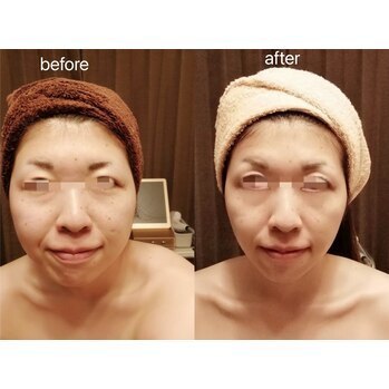 フェイシャル Before/After